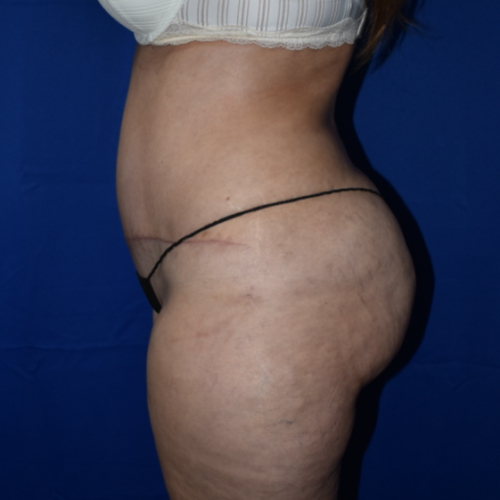 Abdominoplasty