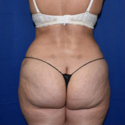 Abdominoplasty