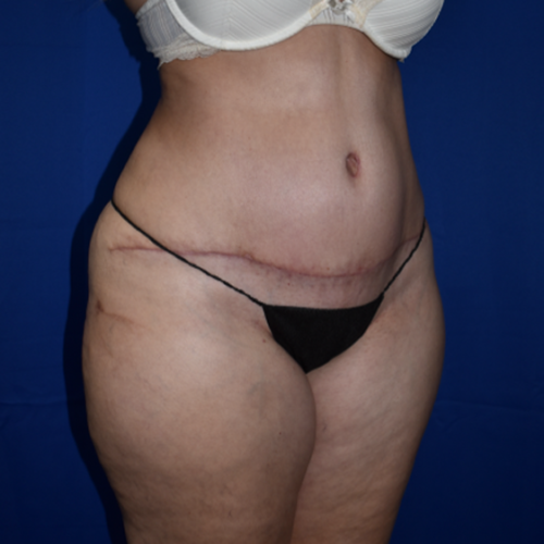 Abdominoplasty