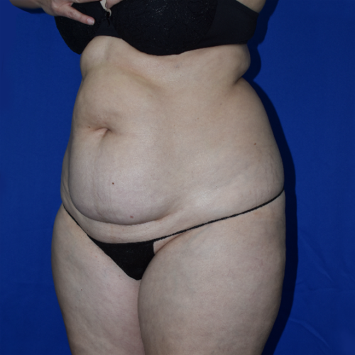 Abdominoplasty