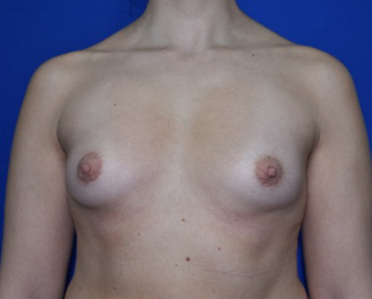 Breast Augmentation