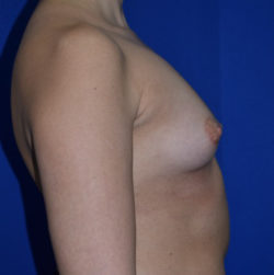 Breast Augmentation