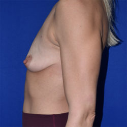 Breast Augmentation With Lift