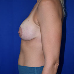 Breast Augmentation With Lift