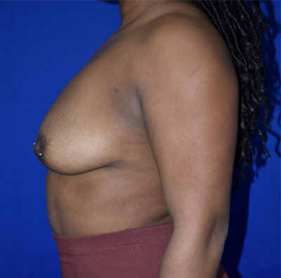 Breast Augmentation With Lift