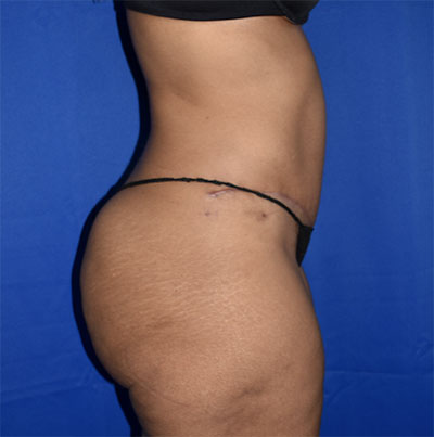 Abdominoplasty