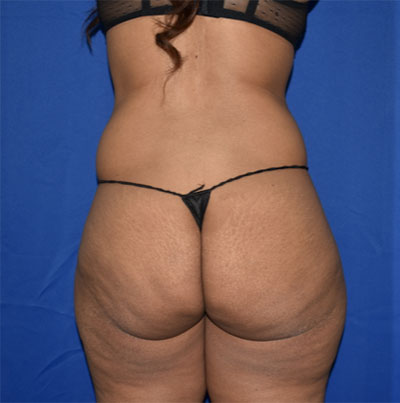 Abdominoplasty