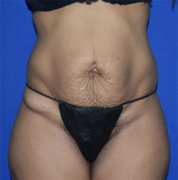 Abdominoplasty