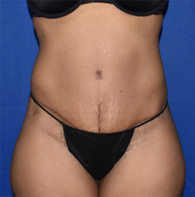 Abdominoplasty