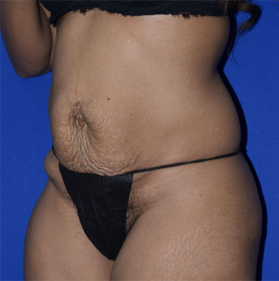 Abdominoplasty