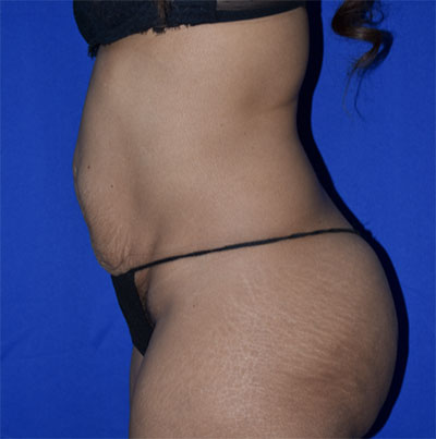 Abdominoplasty