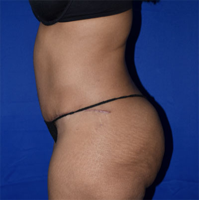 Abdominoplasty