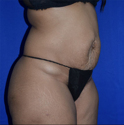 Abdominoplasty