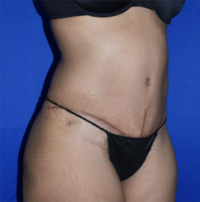 Abdominoplasty