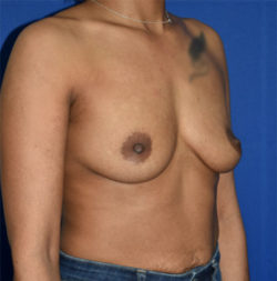 Breast Augmentation