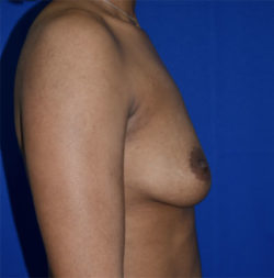 Breast Augmentation