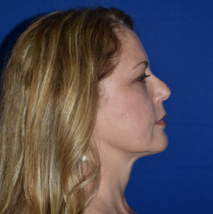 Chin Liposuction