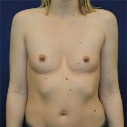 Breast Augmentation