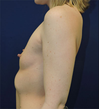 Breast Augmentation