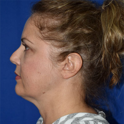 Chin Augmentation