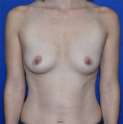 Breast Augmentation