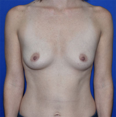 Breast Augmentation