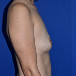 Breast Augmentation