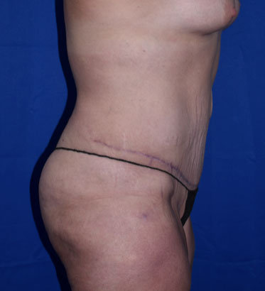 Abdominoplasty