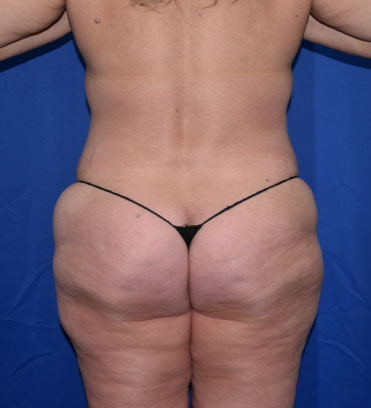 Abdominoplasty