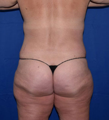 Abdominoplasty