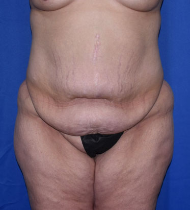 Abdominoplasty