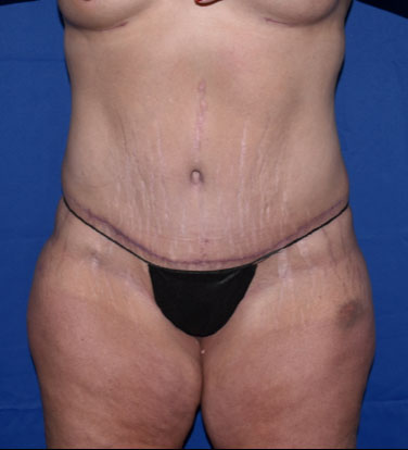 Abdominoplasty