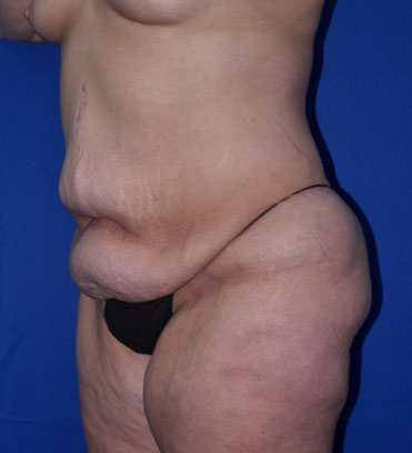 Abdominoplasty