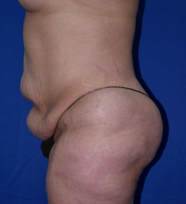 Abdominoplasty