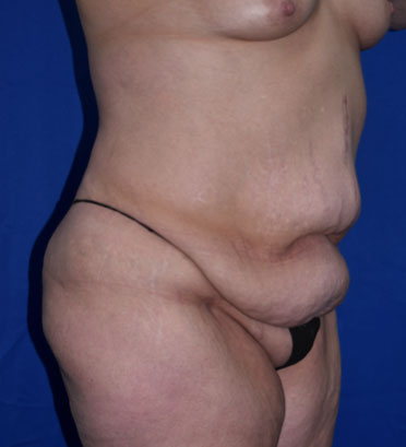 Abdominoplasty