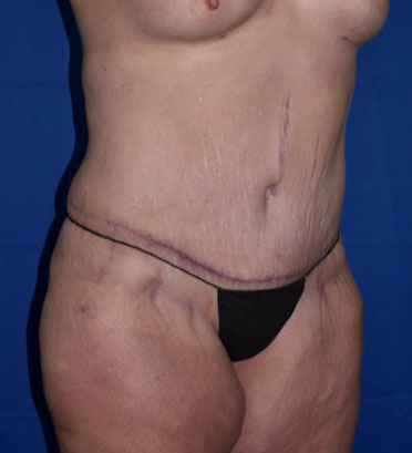 Abdominoplasty