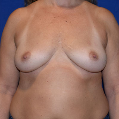 Breast Augmentation