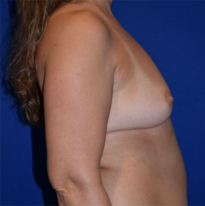 Breast Augmentation