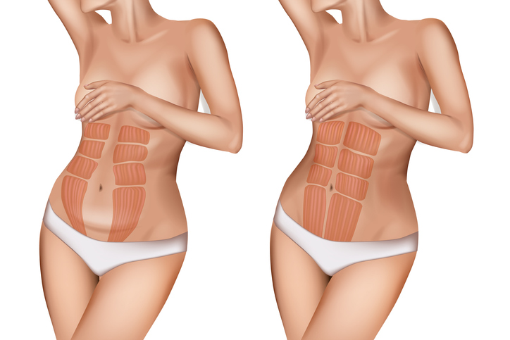 diastasis stock illustration