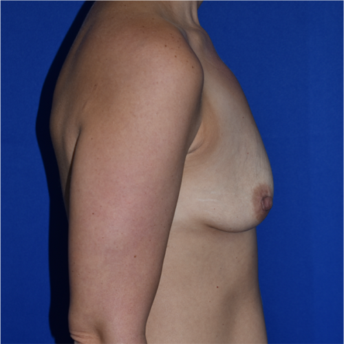 Breast Augmentation