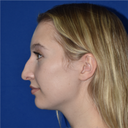 Rhinoplasty