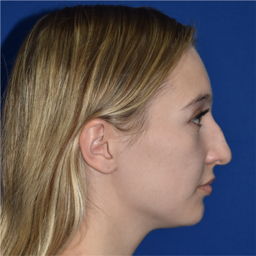 Rhinoplasty