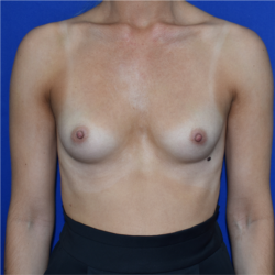 Breast Augmentation