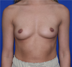 Breast Augmentation