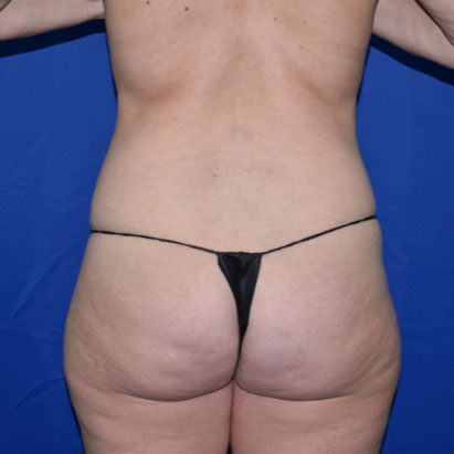 Liposuction