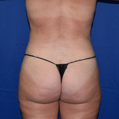 Liposuction