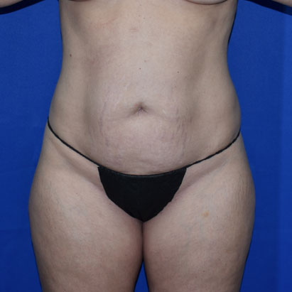 Liposuction