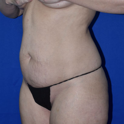 Liposuction