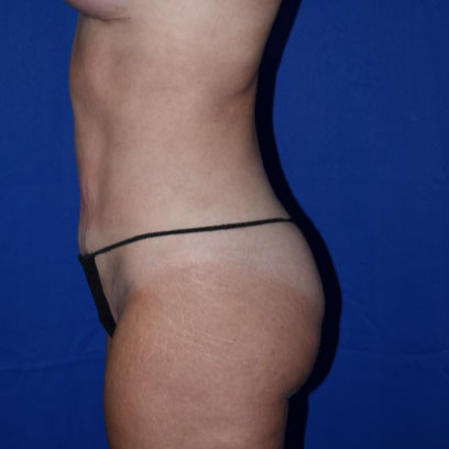 Liposuction