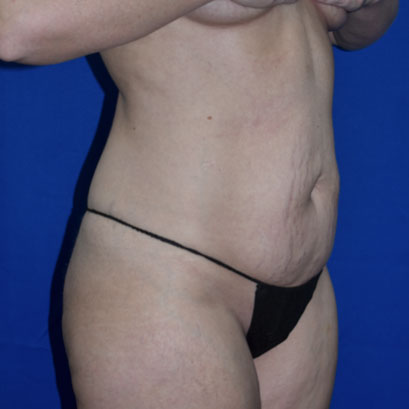 Liposuction